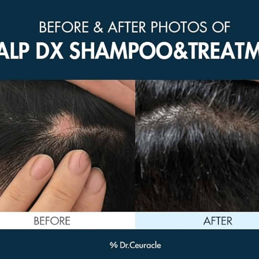 Scalp Dx Scalping Shampoo - WowSkin Romania